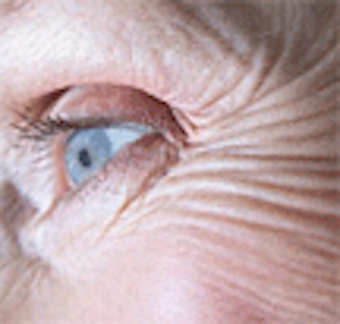 CT.com_wrinkle_eye