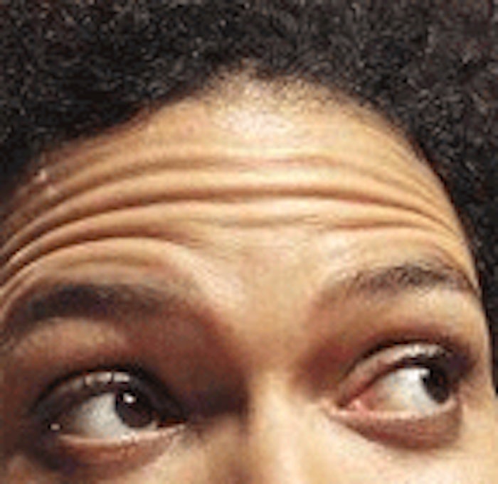 CT.com_wrinkle_forehead