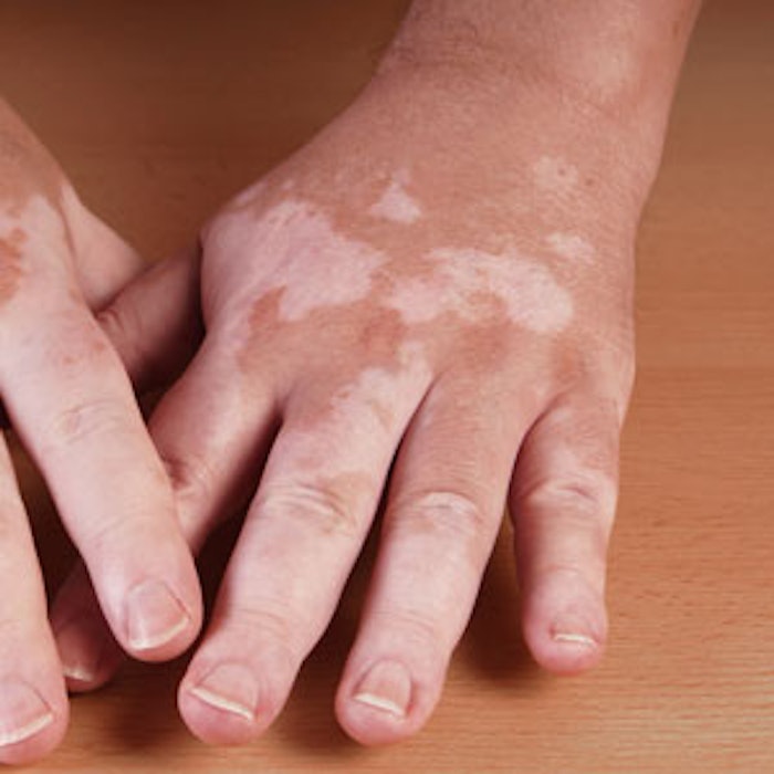 SI_vitiligo_tn