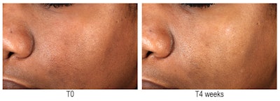 Affects on dark skin