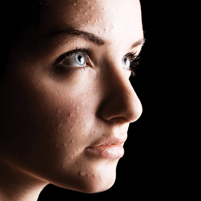 Woman-with-acne-CT1609_Chaudhuri_850