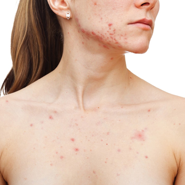 Woman with chest acne-CT1609_Chaudhuri_850