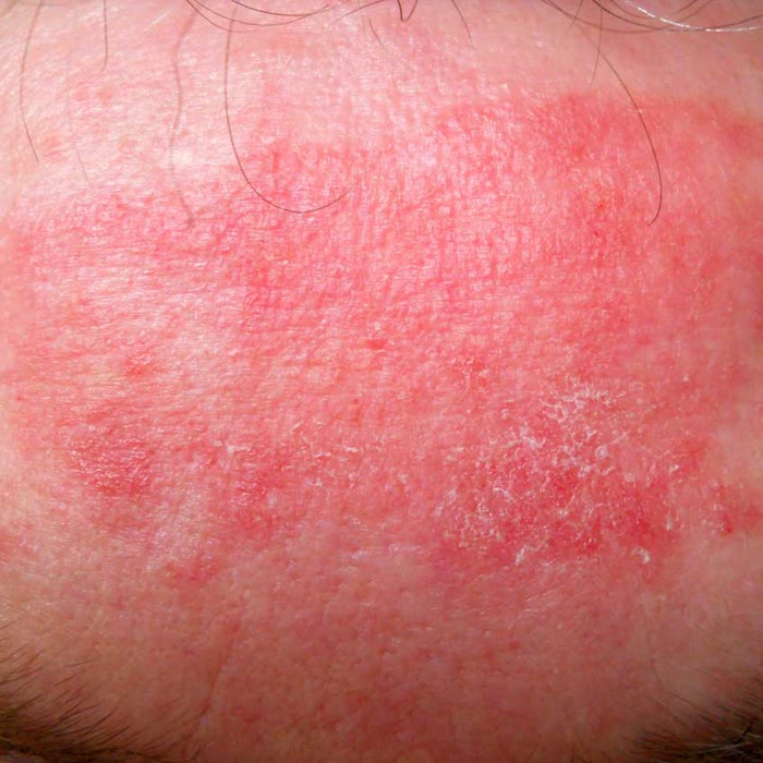 Eczema_850