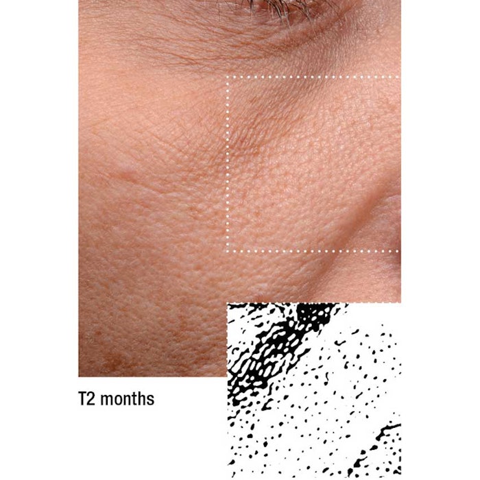 Skin after PoreTect