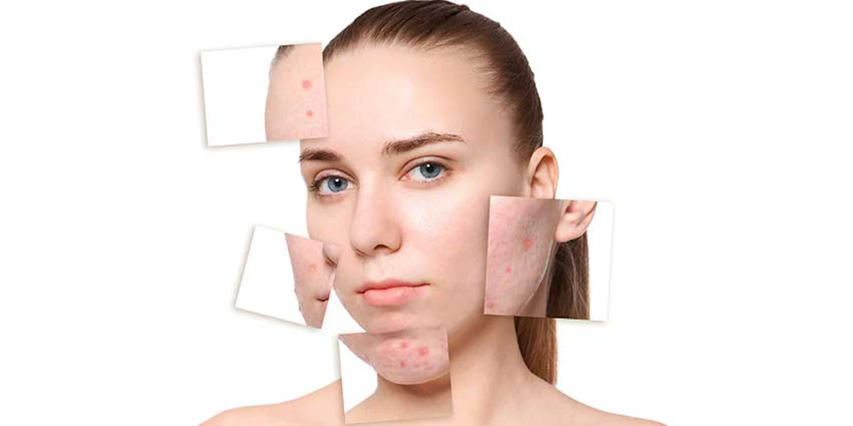 Ortho Dermatologics’ Arazlo Anti-acne Lotion Available in the U.S ...