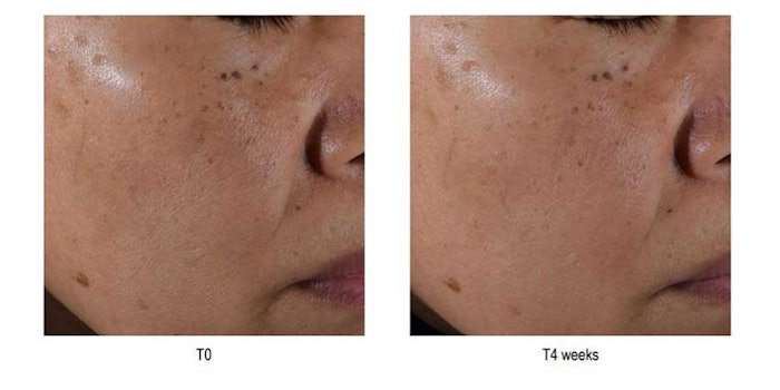 Sederma Pore Tect Updated Results