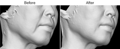 KaoInVivoStudy_NasolabialSmoothingStudy_500