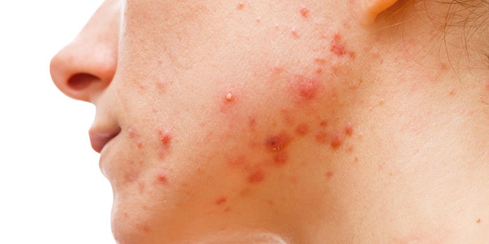 Autophagy Activating Peptide Reduces Acne Research