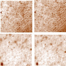 Figure 2 Brown Spots of the right side of face before (Left) and after (Right) 4 weeks’ application.