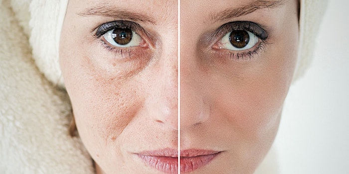 Researchers have developed a device that measures skin glycation.