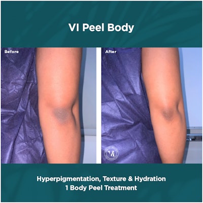 Hyperpigmentation, Texture Hydration