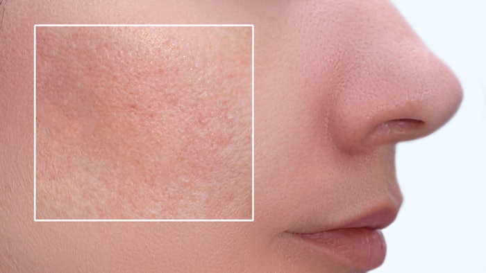Presented at IFSCC, Exsymol was selected for its scientific expertise out of 200 posters for its recent data regarding facial pores.