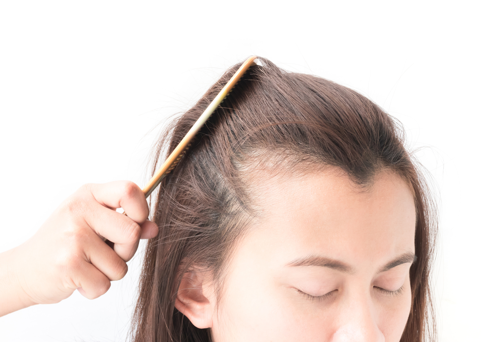 Does Vitamin D Deficiency Lead to Hair Loss? | Discover Magazine