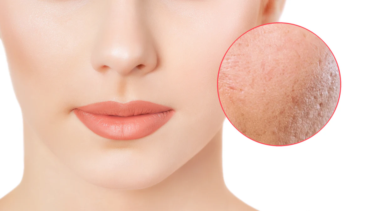 Givaudan's Neoporyl Targets Root Cause of Enlarged Pores - Vimarsana News
