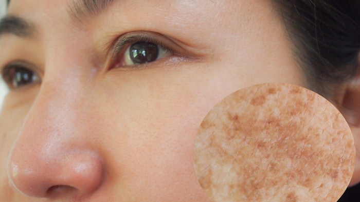 Woman with melasma
