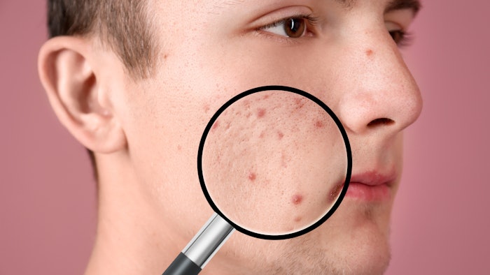 In StratiCELL’s MicroBIOS Platform, the company can now colonize reconstructed epidermis with an IA1 phylotype strain of C. acnes.