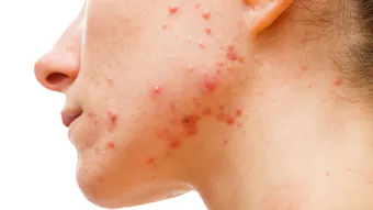 Sun Pharmaceutical’s WINLEVI (clascoterone) cream 1% for the topical treatment of acne vulgaris showed favorable safety and efficacy data.