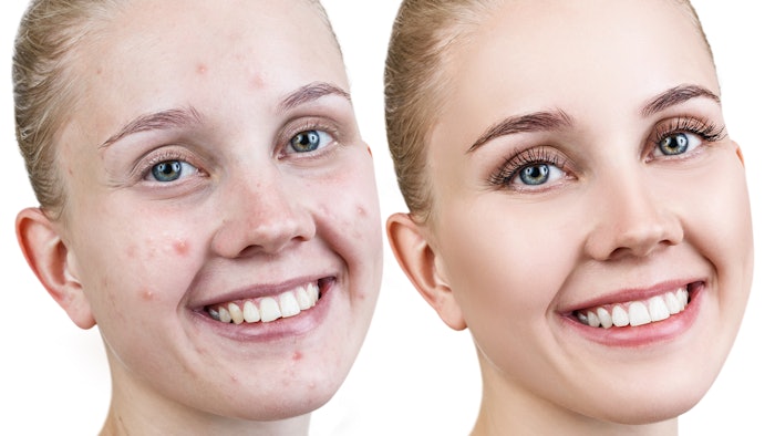 JD Lusteris was found in clinical trials to reduce sebum and restore skin balance for acneic skin.