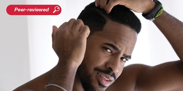 Existing dandruff treatments typically focus on antifungal effects although dandruff is a multicausal condition. Here, dandruff mechanisms and treatments are discussed, and an active based on olive leaf, jujube and levan is tested for its multifunctional effects against M. furfur, dandruff flakes and sebum.