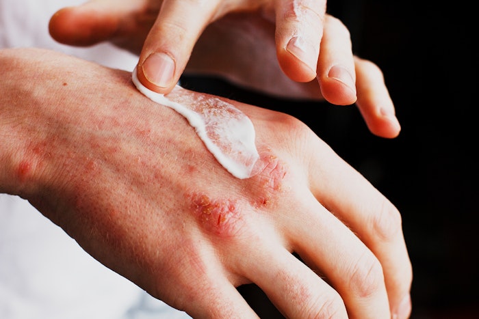 Patient applying psoriasis relief cream
