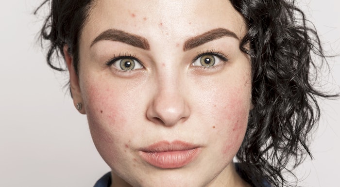 The Cutera research discovered that 90% of moderate to severe acne sufferers said that having acne-free skin would dramatically change the way they live their life.