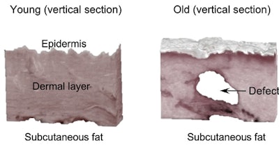 Figure 2. Dermal cavitation