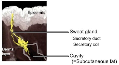 Figure 3. Sweat gland at cavitation site