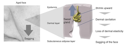 Figure 5. Effect of sweat gland shrinking on cavitation and skin sagging