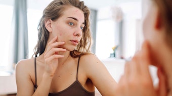 C. acnes induced a large increase in lipids such as triglycerides, ceramides, cholesterol and free fatty acids.