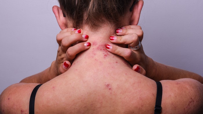 a young girl with atopic dermatitis in the acute stage