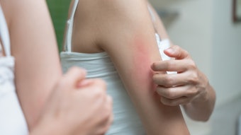 New research points to a signaling pathway that could explain many cases of itchiness on skin.