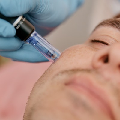 Microneedling treatment