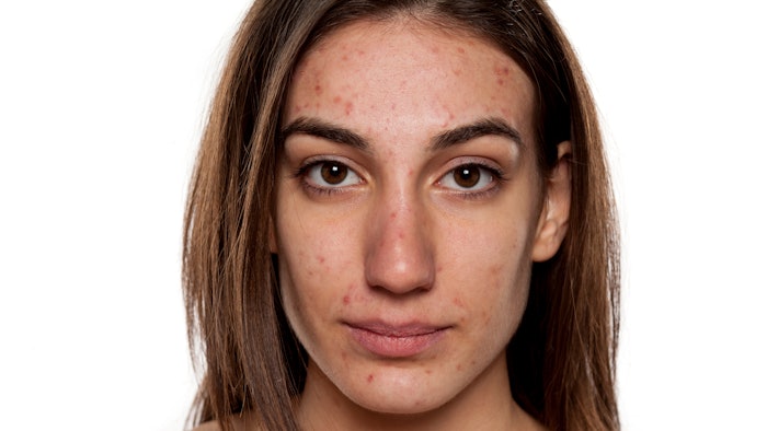 Holistic Acne Webcast