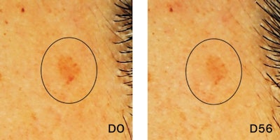 Age spots were noticeably lighter and smaller.
