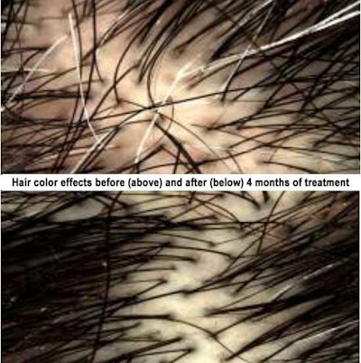 Algaktiv-Densidyl-clinical-efficacy-hair-color-before-after-images