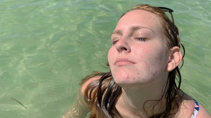 woman-with-acne-at-the-beach-in-the-sun
