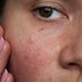 Lead scientist of luxury brand reveals recent findings that may shape the future of inflammation skin care products.