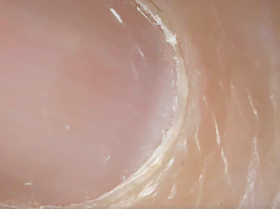 Non Living Tissue Revealed After Pushing Back