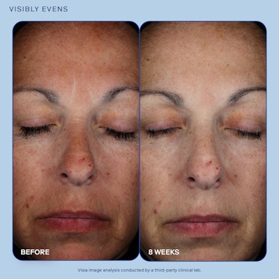 Clinical results show that after just 4 weeks, 100% of users saw significant improvements in fine lines and wrinkles, with an average of 20% improvement after 8 weeks.