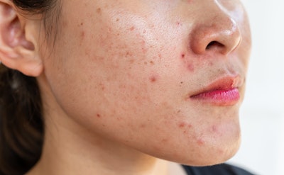 Provital's Pureblome is designed to meet the needs of women aged 30 to 50, a demographic navigating the physical and psychological intersection of aging skin and ongoing acne concerns.