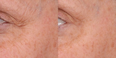 Case 2b: Close crop.