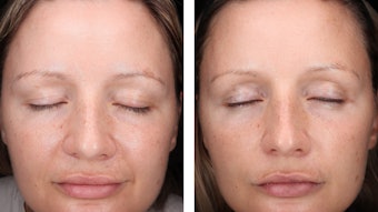 Pictured here is a clinical test subject before/after captured by Visia skin analysis. This image was created during a clinical test of RoC Skincare RoC 35 protocol users. All tests were conducted at clinics in France, with participants aged 45-plus, who reported their skin looked an average of 9.6 years younger after 90 days.