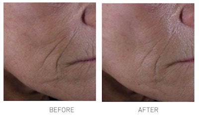 Figure 7. Nasogenian folds before (left) and after (right) treatment with 1% anti-skin sagging active emulsion
