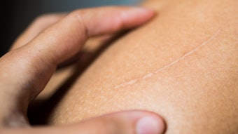 Scar On Shoulder Faded Adobe Stock 484539230