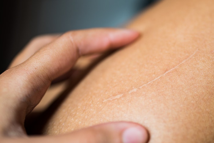 Scar On Shoulder Faded Adobe Stock 484539230