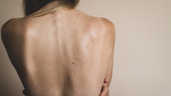 Woman Bare Back Body Acne Concept Facing Away Adobe Stock 369919648