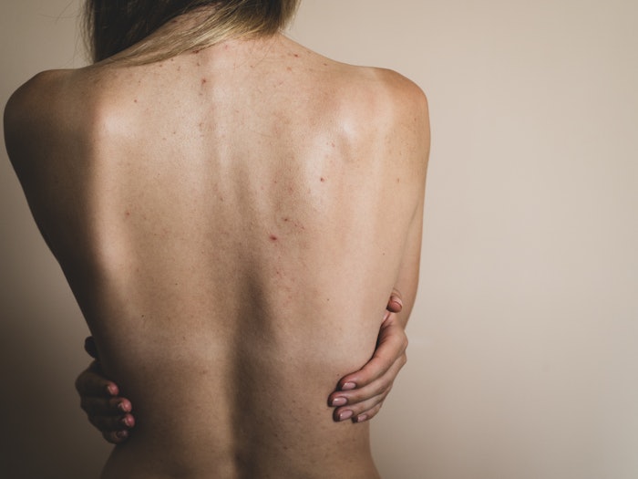 Woman Bare Back Body Acne Concept Facing Away Adobe Stock 369919648