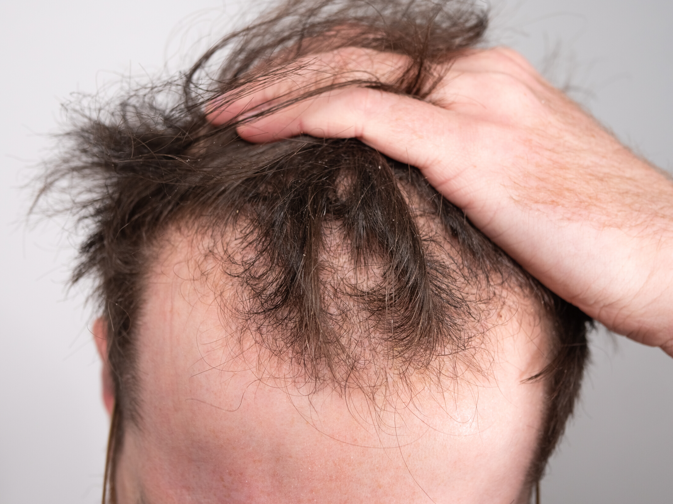 Man Hand In Hair Thinning On Top Alopecia Adobe Stock 473136928
