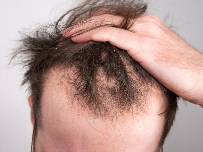 Man Hand In Hair Thinning On Top Alopecia Adobe Stock 473136928