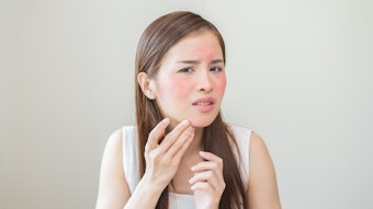Woman With Itchy Red Skin Irritated Hurt Red Adobe Stock 1096675647